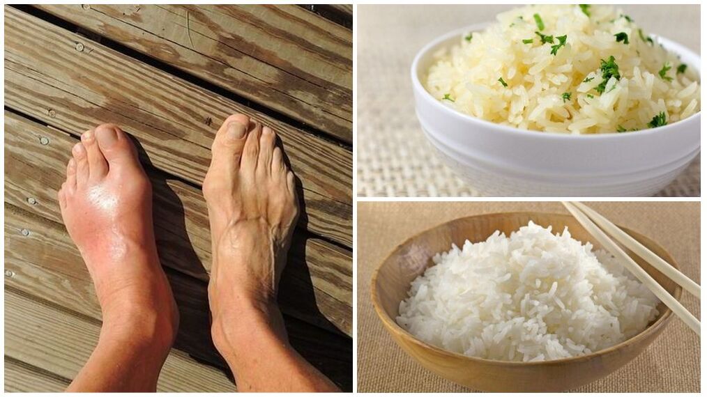 Uma dieta à base de arroz é recomendada para pacientes com gota. 